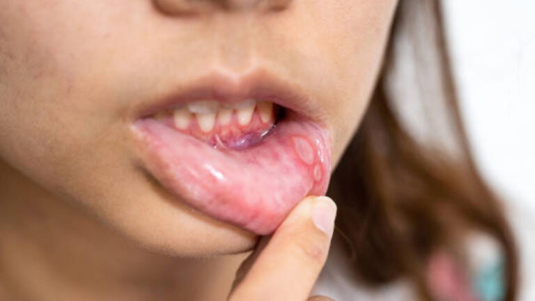 uzmani uyardi 2 haftadan uzun suren agiz yaralari ihmal edilmemeli 9PWmIanV